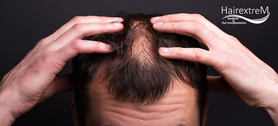 Après une greffe de barbe DHI quelles sont les choses auxquelles ils font prêter attention?