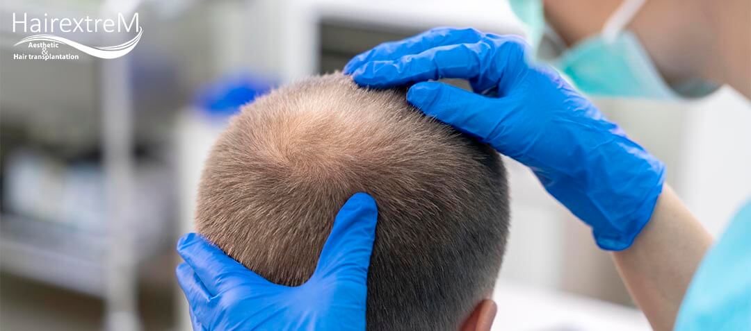 Combien de greffon sont nécessaire pour une greffe capillaire?