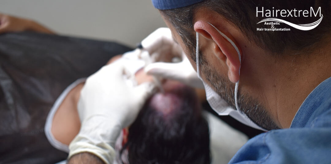 Comment choisir une clinique de greffe de cheveux?