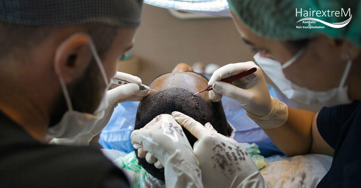 Comment faire une greffe de cheveux en Turquie combien ça coûte?