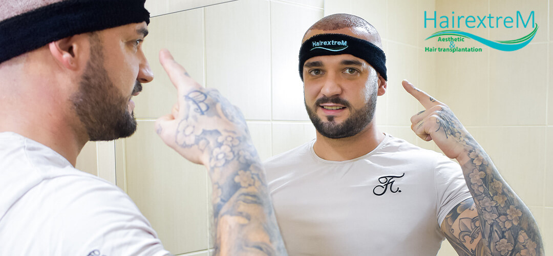 Quand doit-on faire une greffe de cheveux?