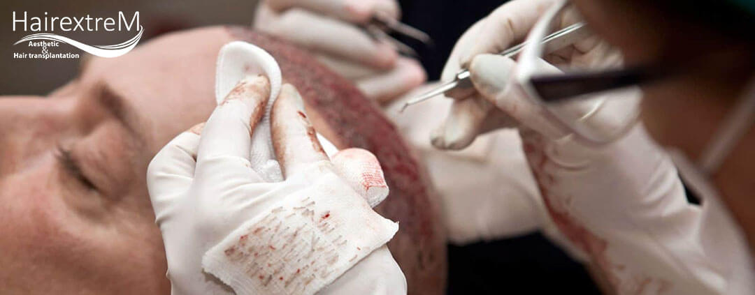 Quelle est la meilleure méthode de greffe de cheveux?