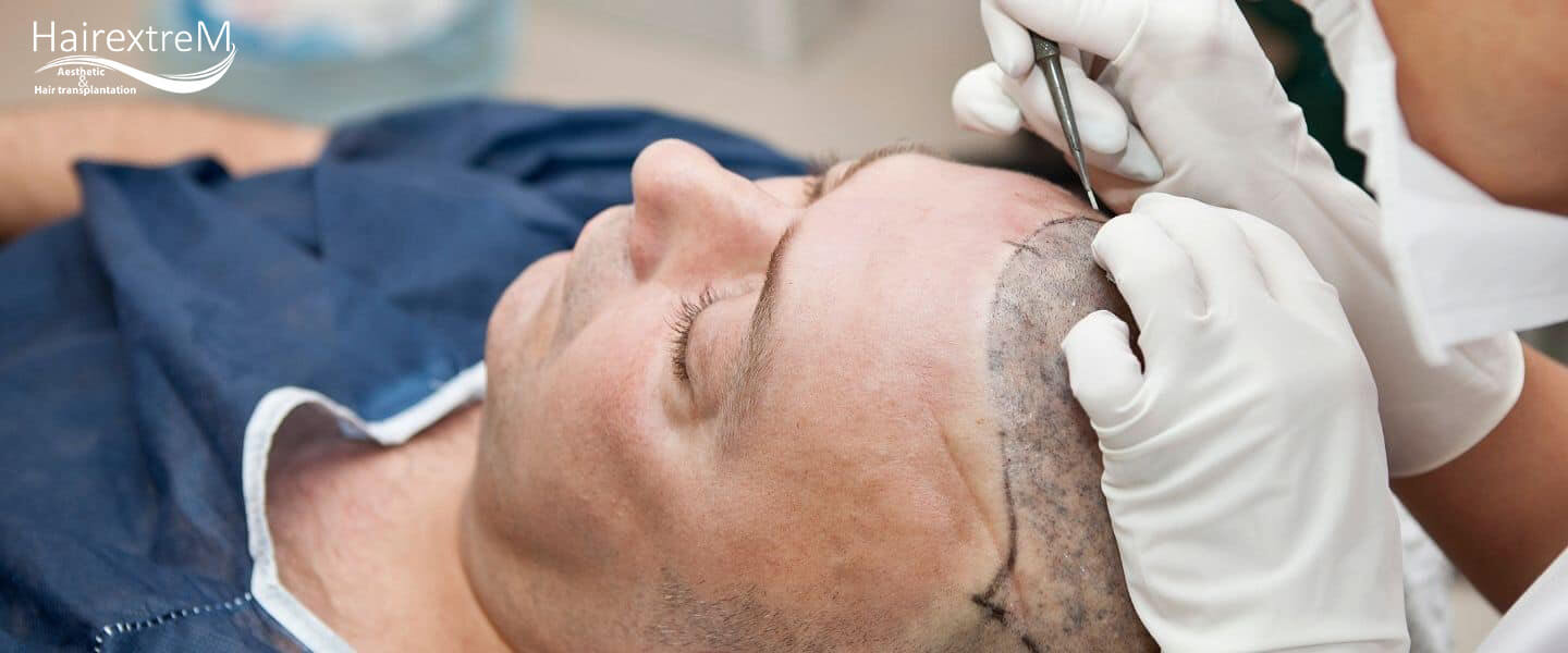 Qu'est-ce qui détermine le coût de la greffe de cheveux en Turquie